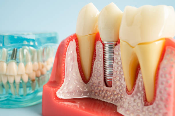 Best Wisdom Tooth Removal  in Midway, UT